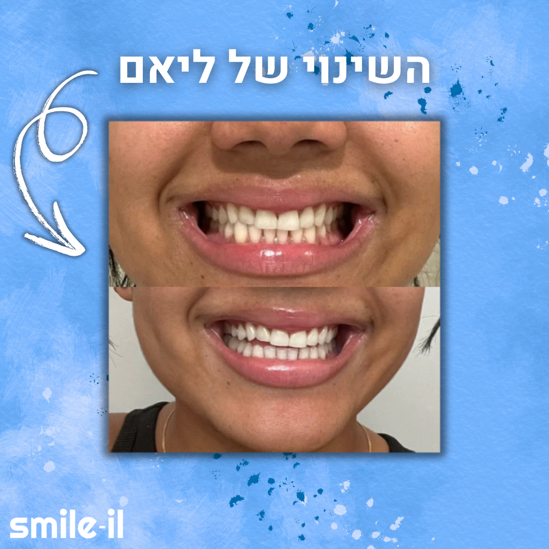 SMILEIL STRIPS™ - רצועות הלבנה