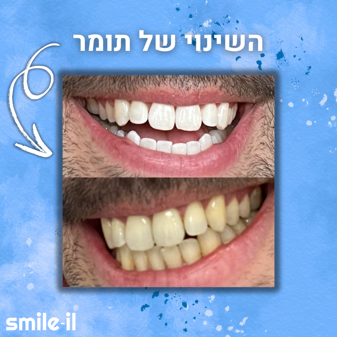 SMILEIL KIT™ - מארז הלבנה